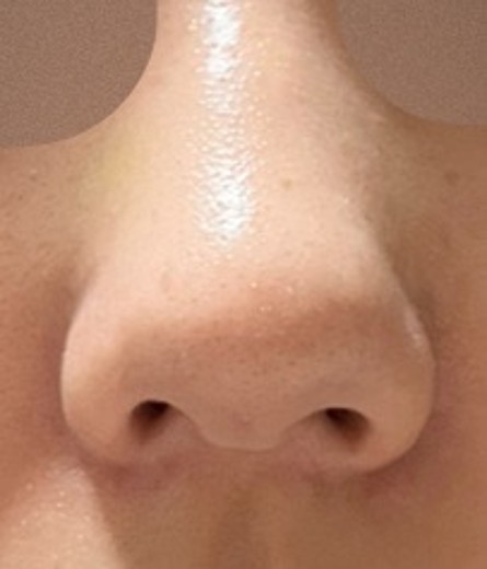 after photo: 小鼻ボトックス, 脂肪溶解注射(顔)