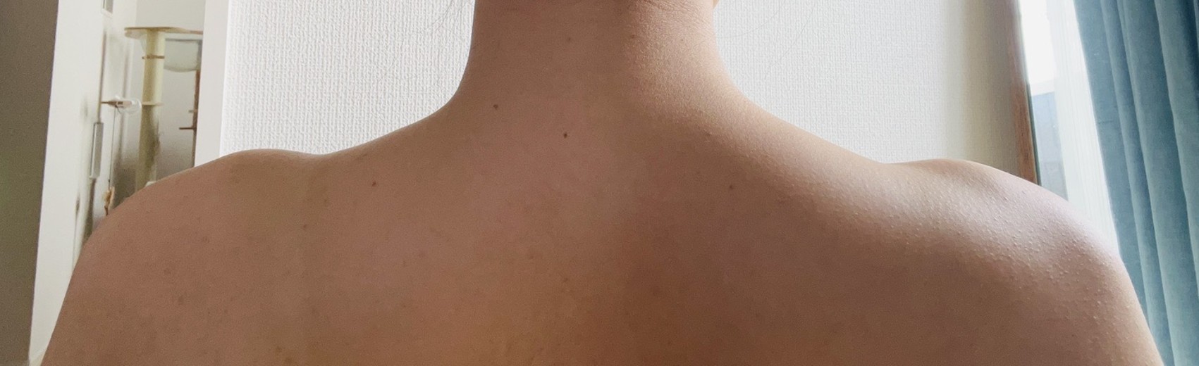 after photo: 脇ボトックス, エラボトックス, 肩ボトックス(僧帽筋)