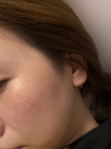 before photo: ピコトーニング