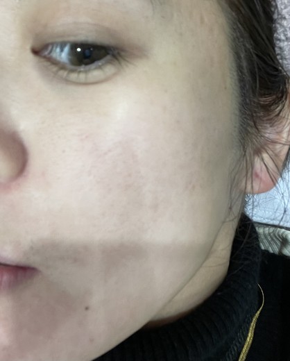 before photo: ダーマペン