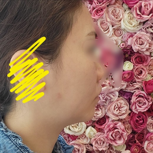 before photo: リニアファーム(ハイフ)