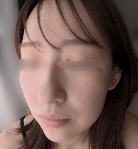 before photo: IPL(光/フォト治療), ピーリング