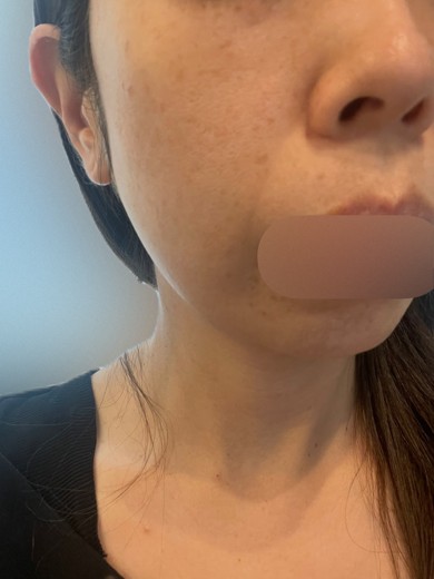 before photo: フラクショナルレーザー, エレクトロポレーション