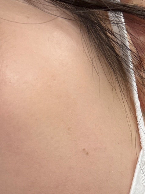 アクアピール＋エレクトロポレーション【薬剤代込】【再来OK