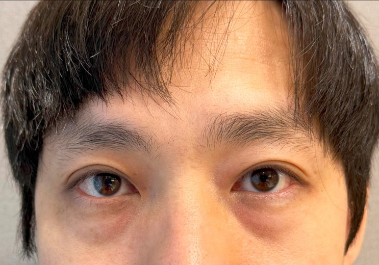 before photo: 눈밑지방재배치