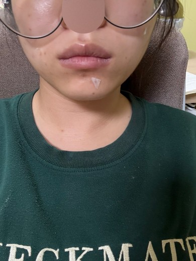 after photo: 여드름압출, 여드름주사