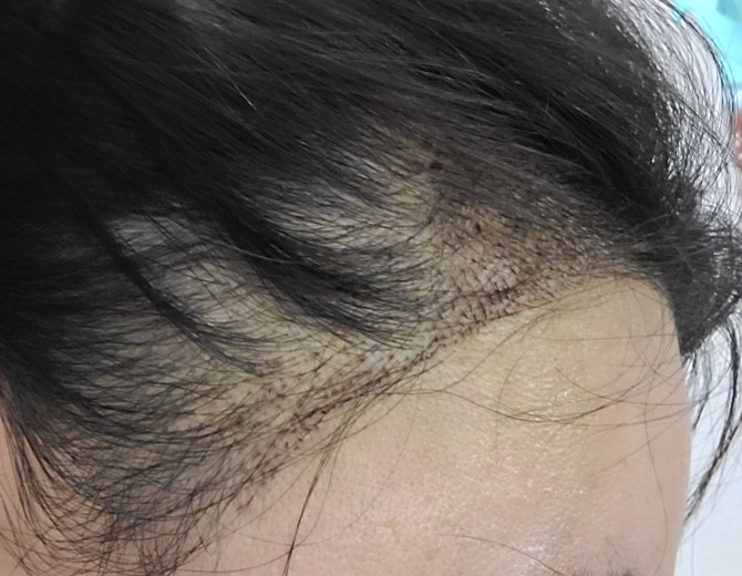 after photo: 머리모발이식