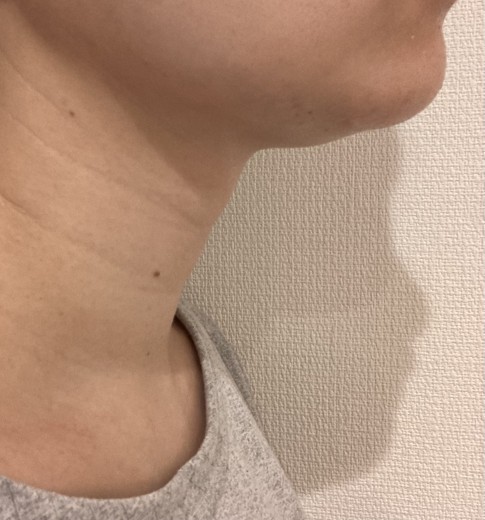 after photo: 脂肪溶解注射(顔)