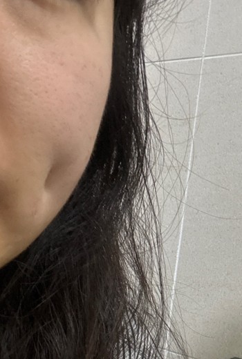 after photo: 보조개성형