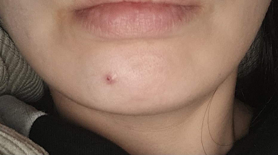 after photo: 침샘보톡스