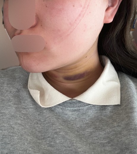 after photo: 脂肪吸引注射