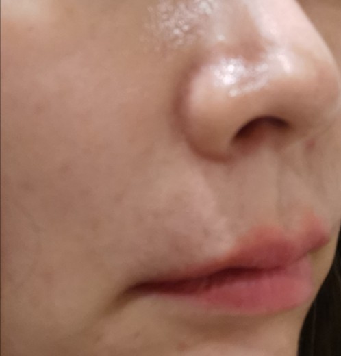 before photo: 脂肪溶解注射(顔)