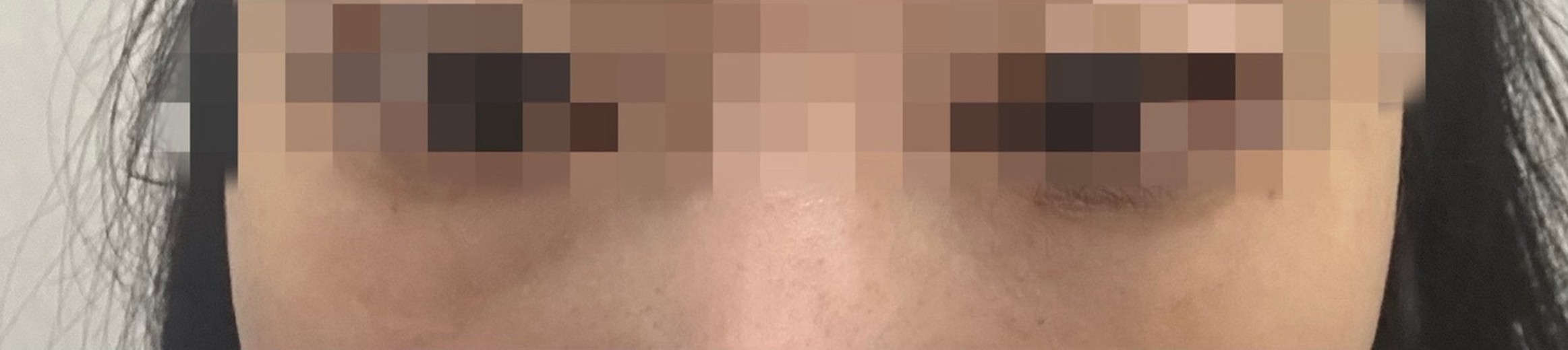 before photo: 눈밑필러