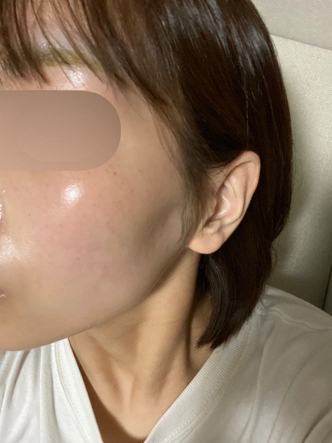 エレクトロポレーション 美肌への近道！】湘南美容クリニックのエレクトロポレーション