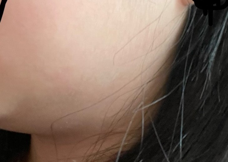 before photo: 인모드리프팅