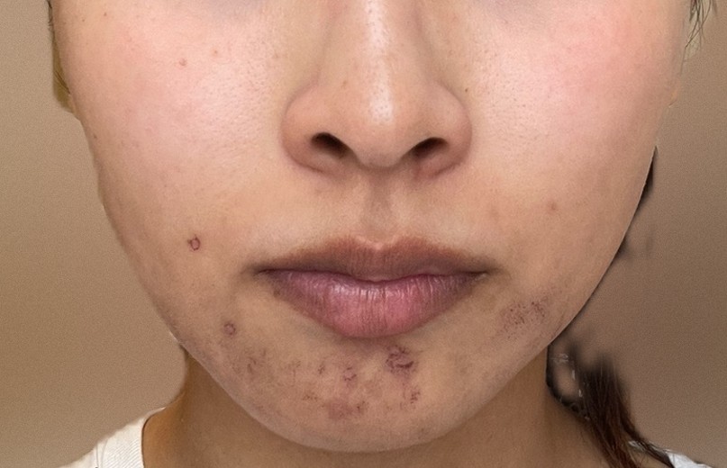 after photo: IPL(光/フォト治療), ルメッカ