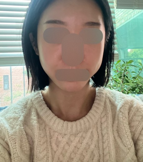 after photo: 턱끝필러