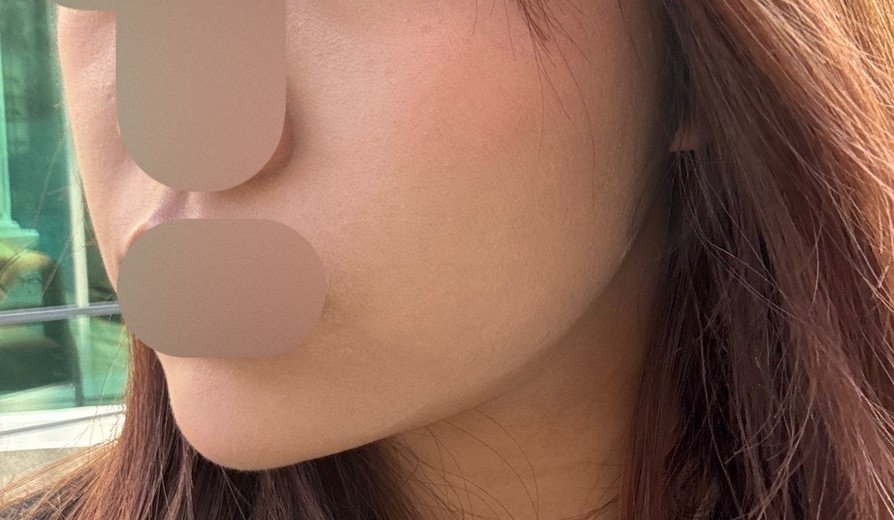 after photo: 턱끝필러