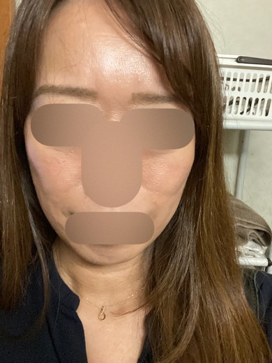 after photo: マッサージピール(コラーゲンピール)