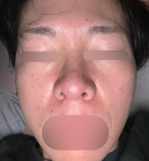after photo: ダーマペン