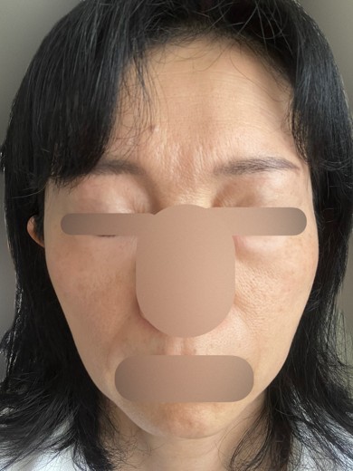 before photo: エレクトロポレーション