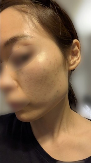 after photo: 脂肪溶解注射(腕), 脂肪溶解注射(太もも)
