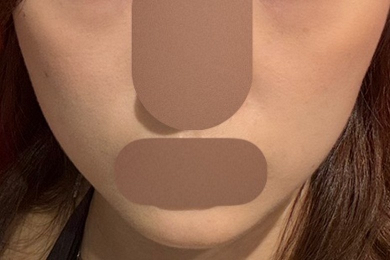 after photo: 온다리프팅