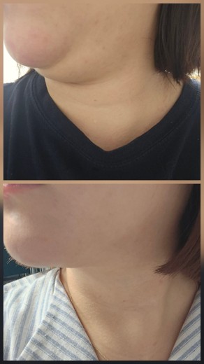 after photo: 울쎄라리프팅, 침샘보톡스, 브이올렛주사