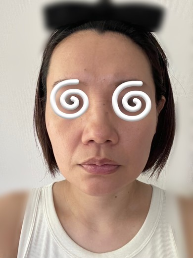 after photo: 眉間ボトックス, 脇ボトックス, エラボトックス