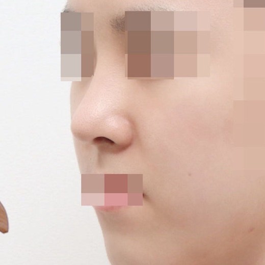 after photo: 콧대(자가조직), 콧대(보형물)