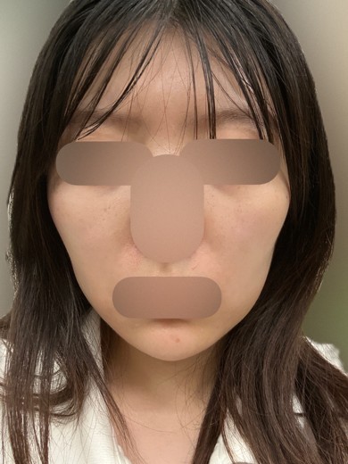 after photo: 脂肪吸引(頬)