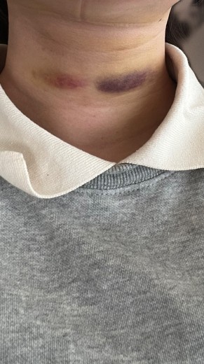 after photo: 脂肪吸引注射