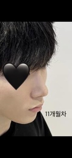 after photo: 코끝(자가연골), 복코교정(수술)