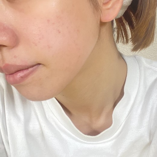 after photo: IPL(光/フォト治療)