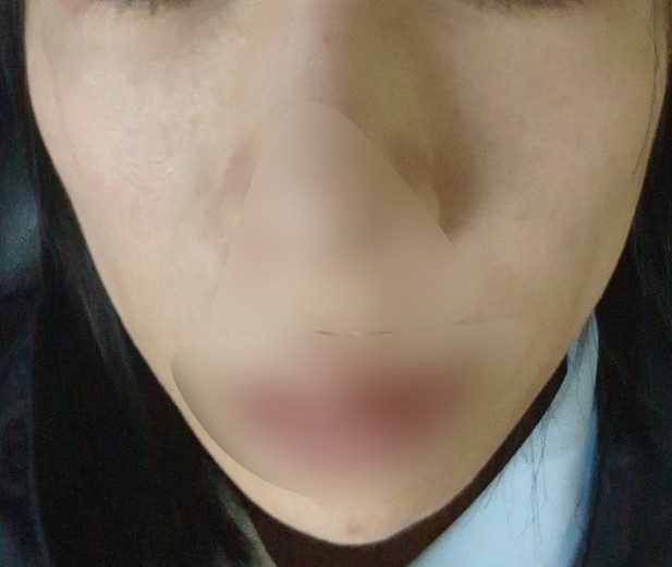 before photo: IPL(光/フォト治療)