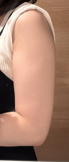 after photo: 脂肪冷却(腕)