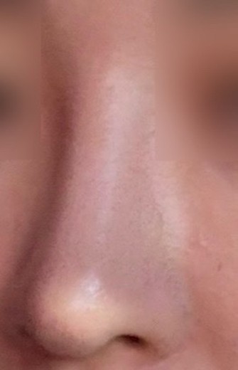 after photo: 콧대(보형물), 코끝(자가연골)