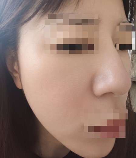 after photo: IPL(光/フォト治療), ピーリング, エレクトロポレーション