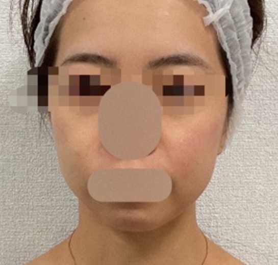 after photo: チタニウムリフト