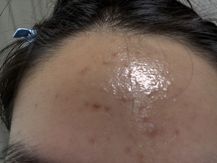 after photo: 스킨스케일링, 여드름압출