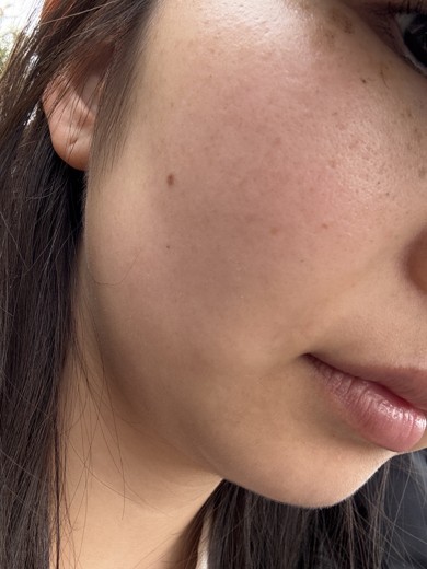after photo: IPL(光/フォト治療)
