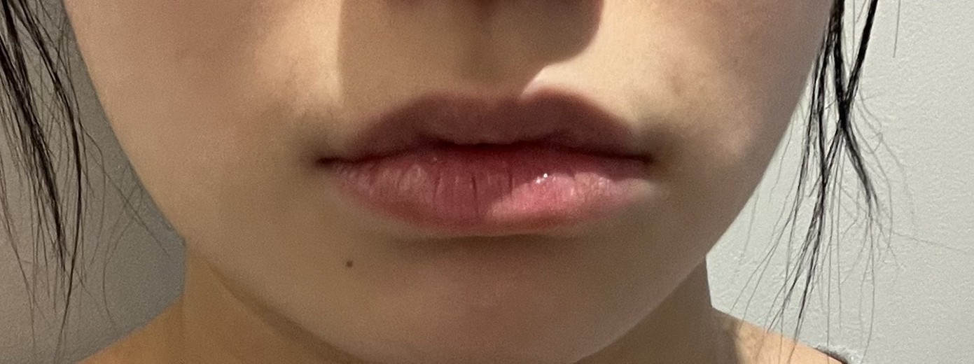 before photo: 입술필러