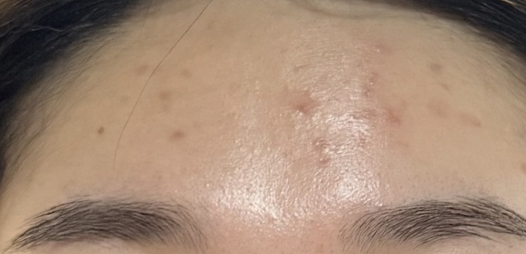 after photo: 스킨스케일링, 여드름압출, 여드름주사