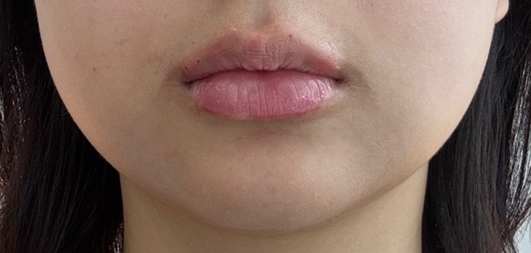 after photo: 입술필러