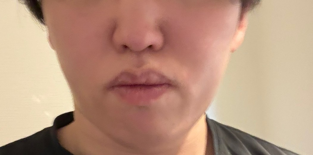 before photo: 脂肪溶解注射(顔)