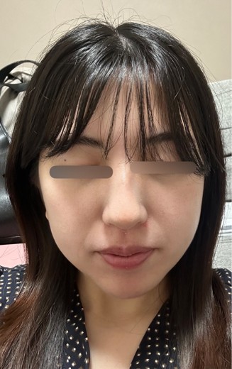 after photo: ミラノリピール