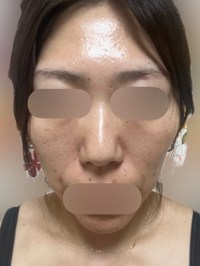 after photo: マッサージピール(コラーゲンピール)