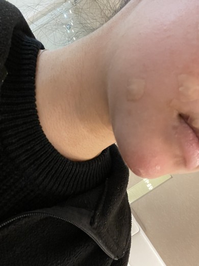 after photo: 턱끝보톡스, 턱끝필러