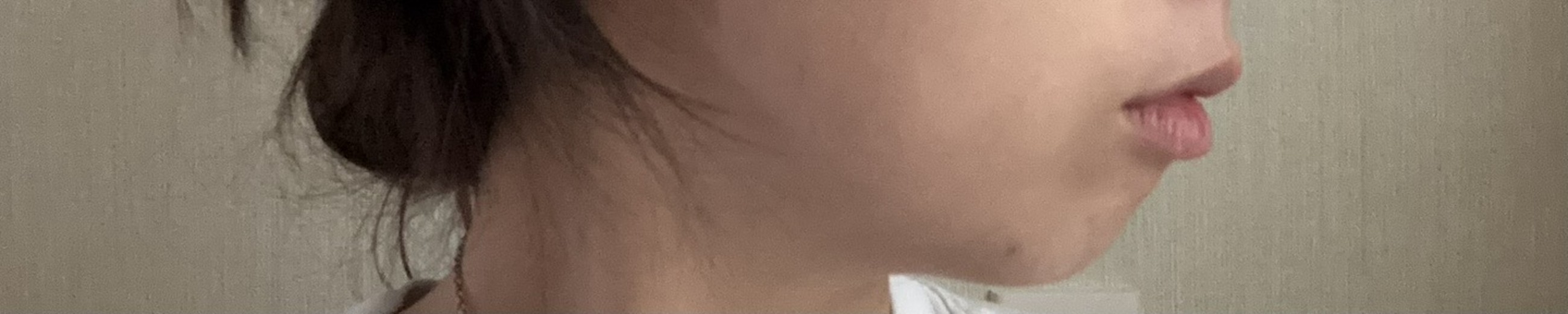 before photo: 턱필러