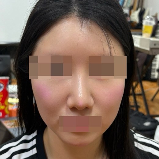 after photo: 코재수술, 콧대(보형물), 복코교정(수술)